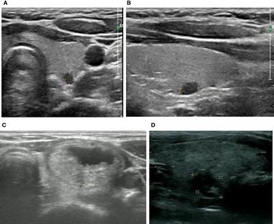 The diagnostic efficacy and inappropriate biopsy rate of ACR TI-RADS and ATA guidelines for thyroid nodules in children and adolescents